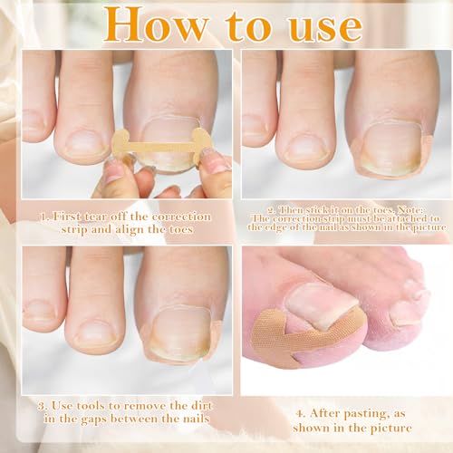Ingrown Toenail Removal Kit with Pedicure Tools (105-Piece Set)