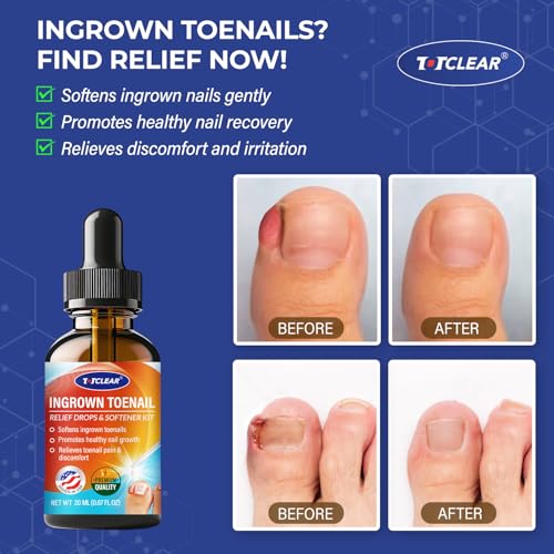 Ingrown Toenail Relief Kit: Home Treatment Tools