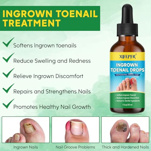 Ingrown Toenail Relief Drops, 30ml